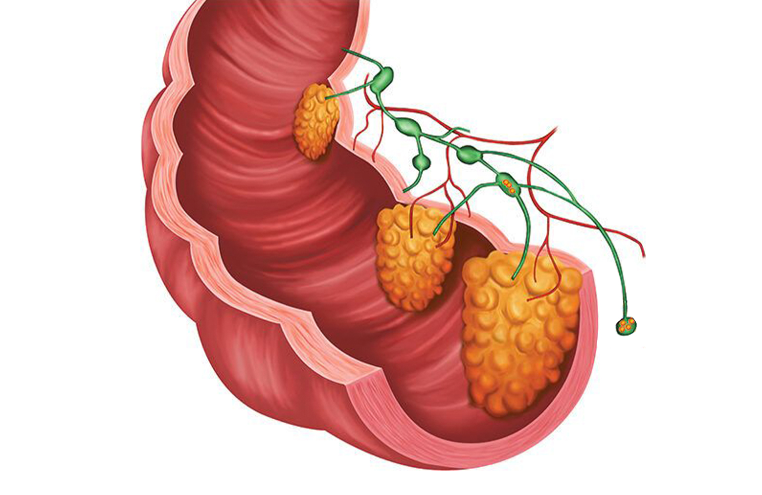 Kolon ve Rektum Kanseri
