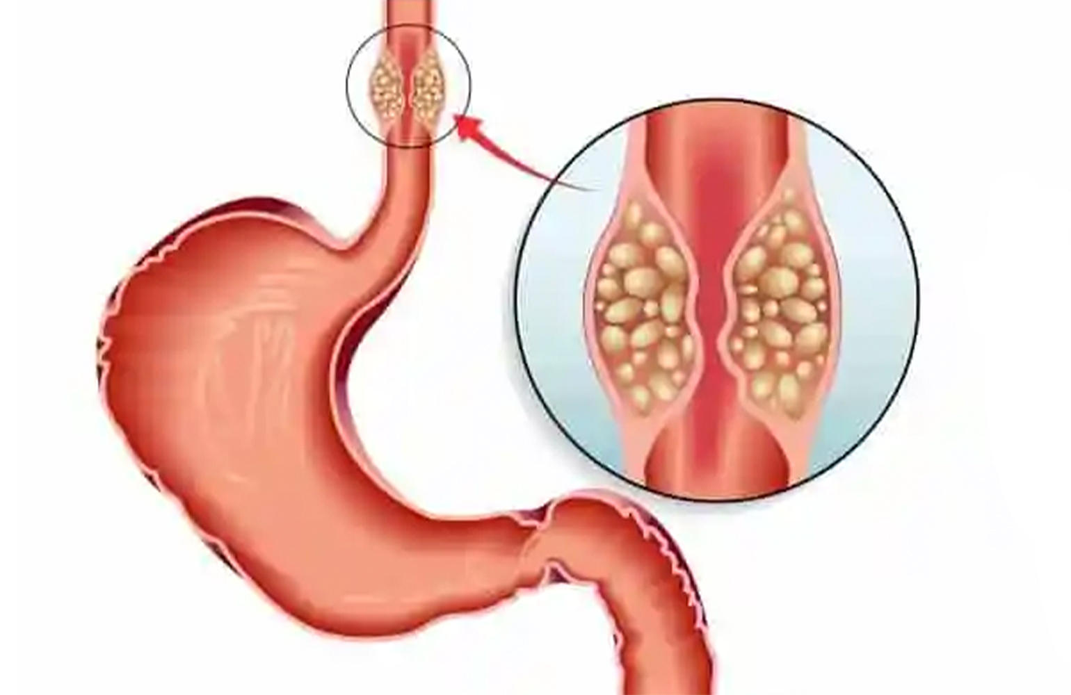 Özofagus (Yemek Borusu) Kanseri