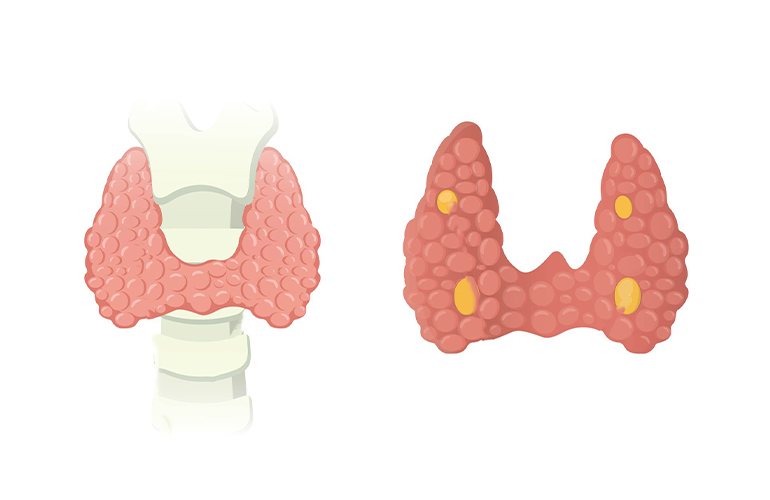 Paratiroid Cerrahisi